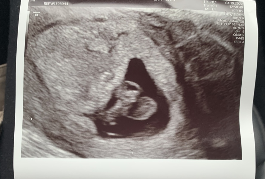 7 weeks scan after bleeding