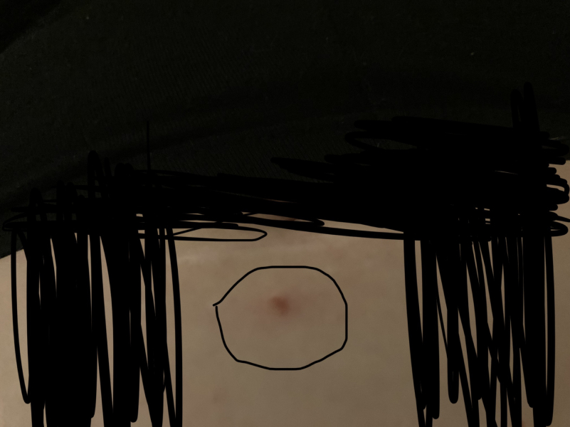 Does this look like a suspicious mole ?