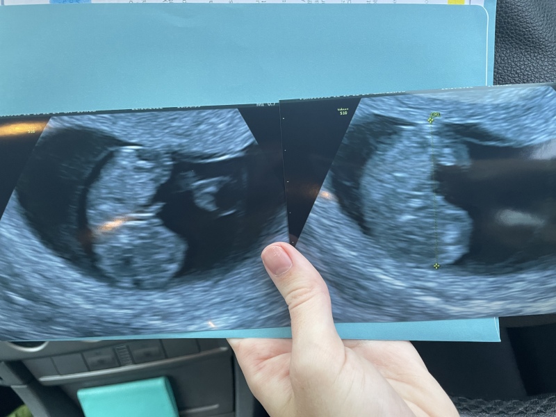 Very early pregnancy and so much anxiety after miscarriage