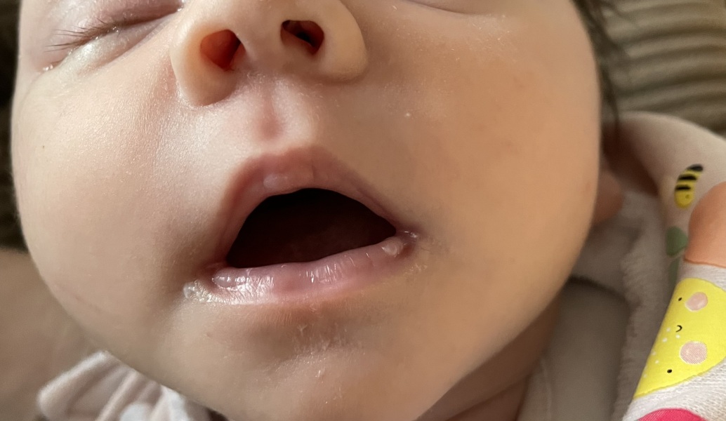 What could this be on baby's lip ?