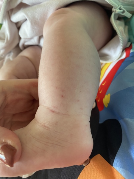 Meningitis scare