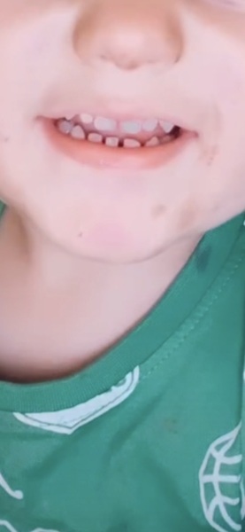 2.5y/o missing front tooth.