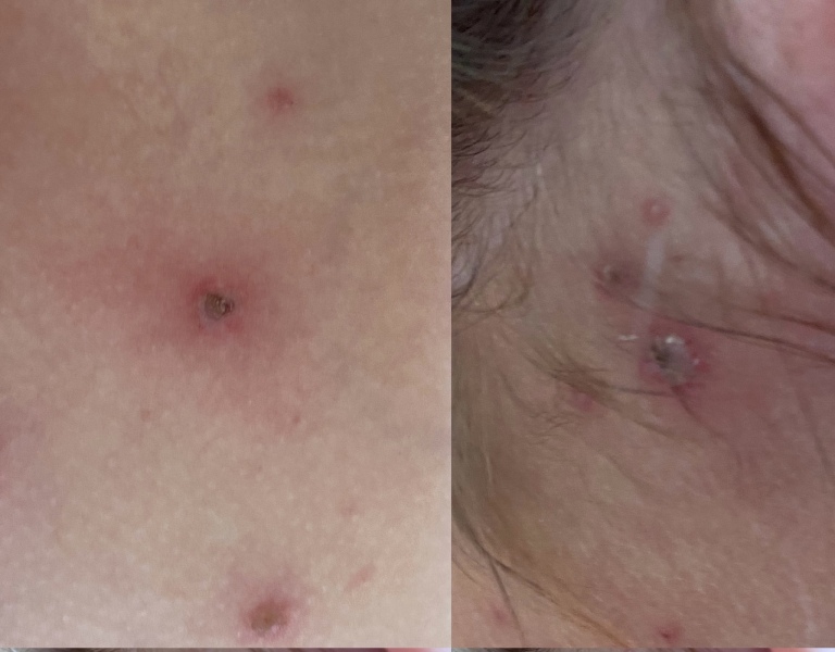 Do these chickenpox spots look infected?