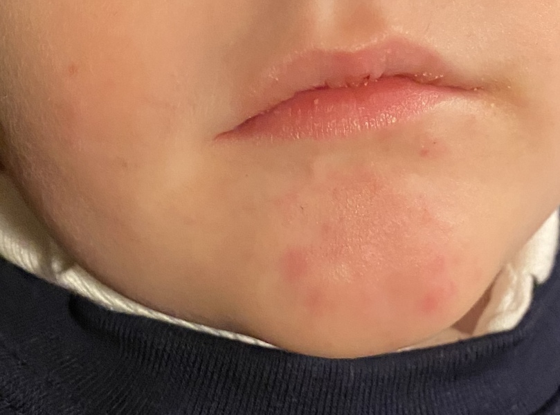 5 year old spotty face