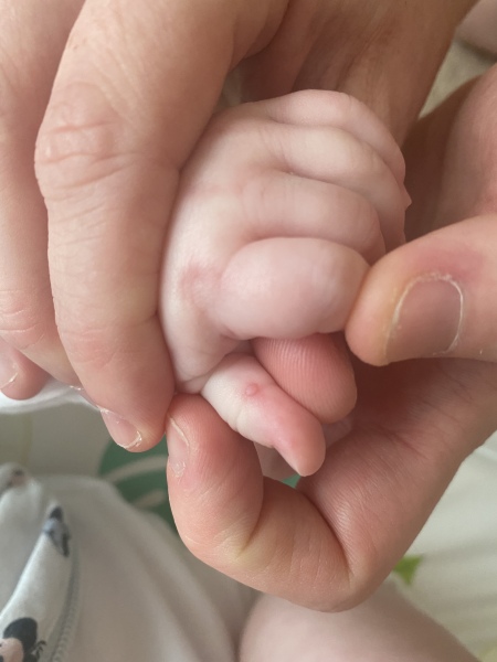 Hand foot and mouth