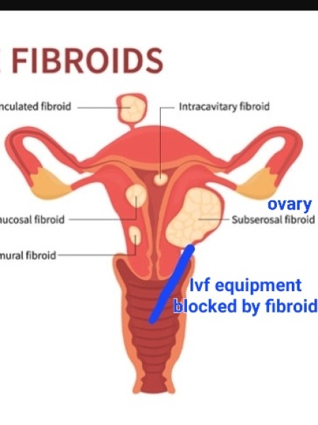 IUI again after failed IVF?