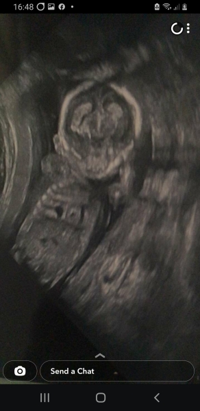 Cystic space on baby heart