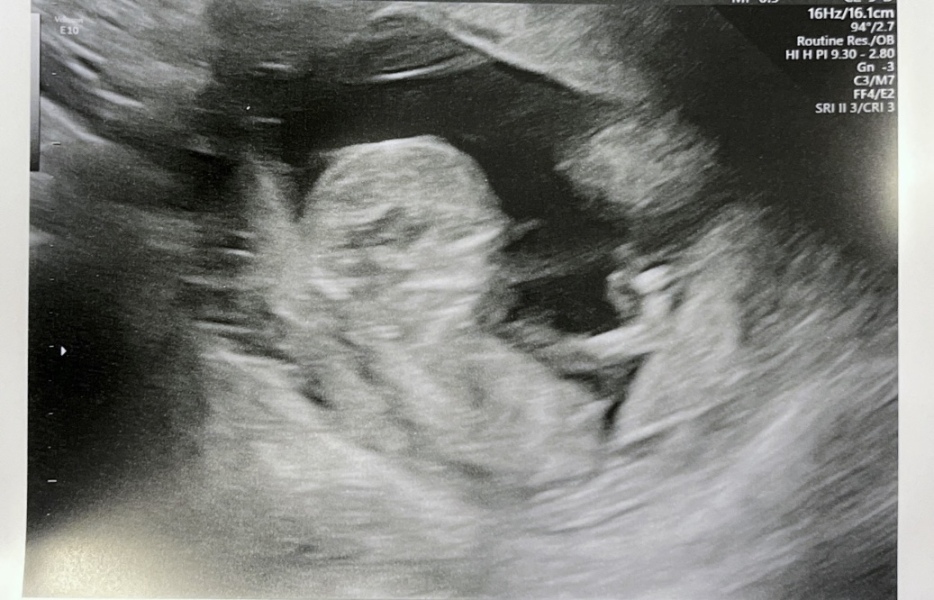 Any nub experts? Awkward scan position!