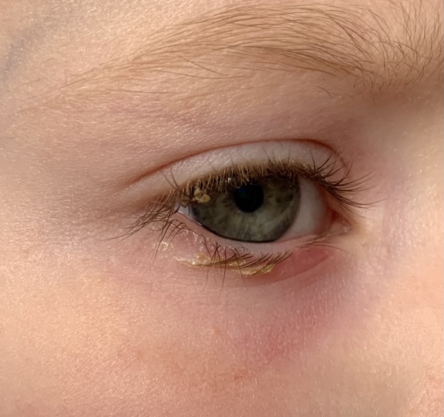 Conjunctivitis? Drops or leave alone?