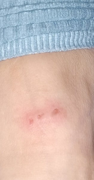 Insect bites or something else? (photo included)