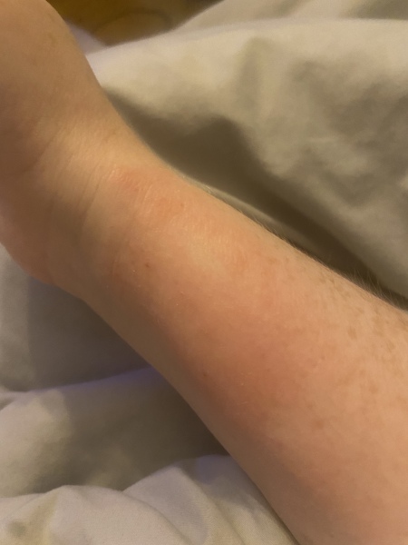 To be worried by this rash 