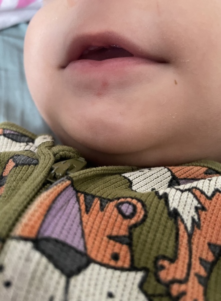 Hand foot and mouth