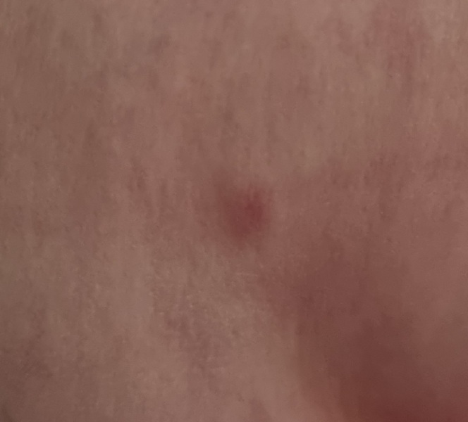 Do I need this lump looked at? getting a bit worried. 