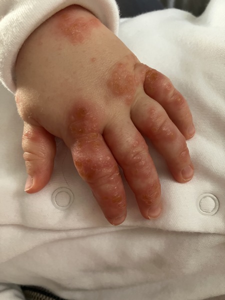 10mo rash - help!