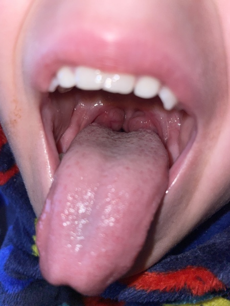 Enlarged tonsils in DS 5/repeated vomiting/sleep disturbance. Wwyd?