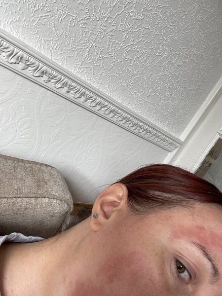 Please help identify this rash