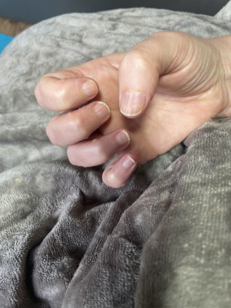 Nail ridges when you can't wear polish?