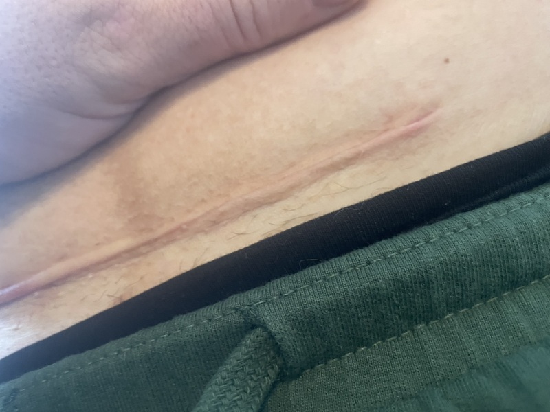 C section scar (picture)