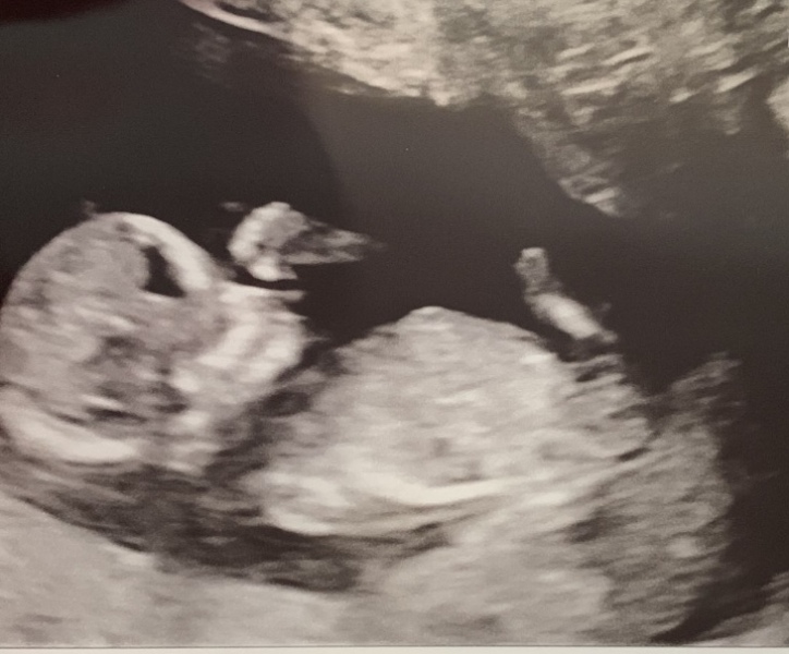 Nub theory- girl or boy?! 