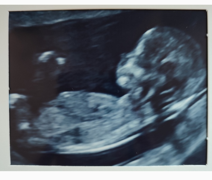 Can you see a nasal bone? 13 week scan pic
