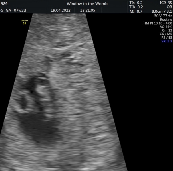 7+4 early scan?