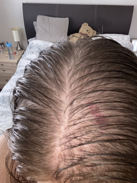 Hair loss from under active thyroid