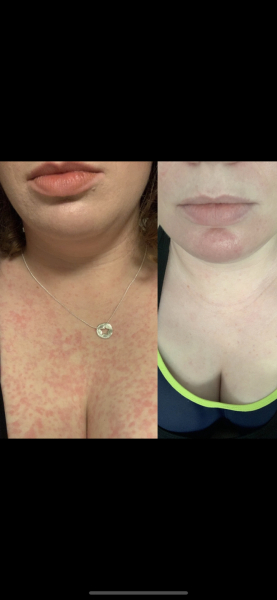 Chronic Urticaria - I'm miserable