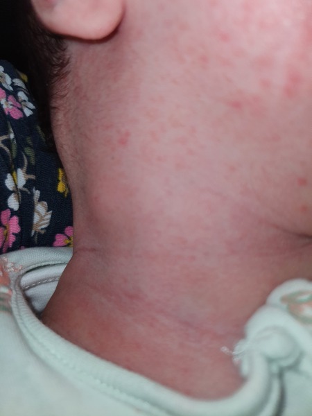 Lumps in 5 week old babies neck- really worried