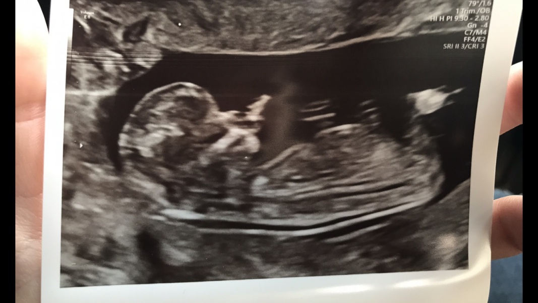 Comparing scans - convinced I am having a girl - HELP