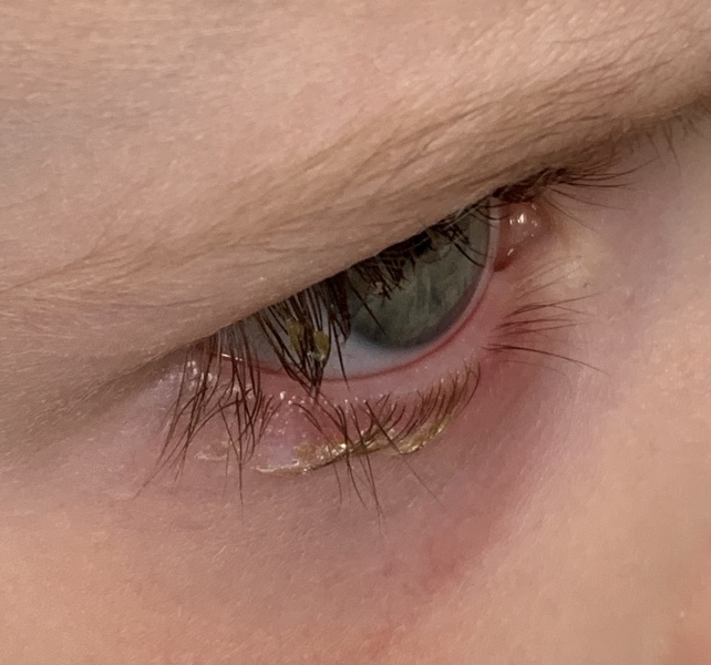 Conjunctivitis? Drops or leave alone?