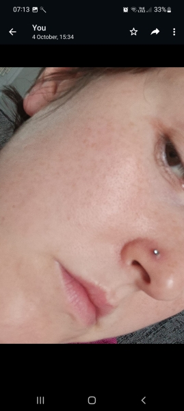 Looking for nose piercing advice- piercing bump/ keloid ?