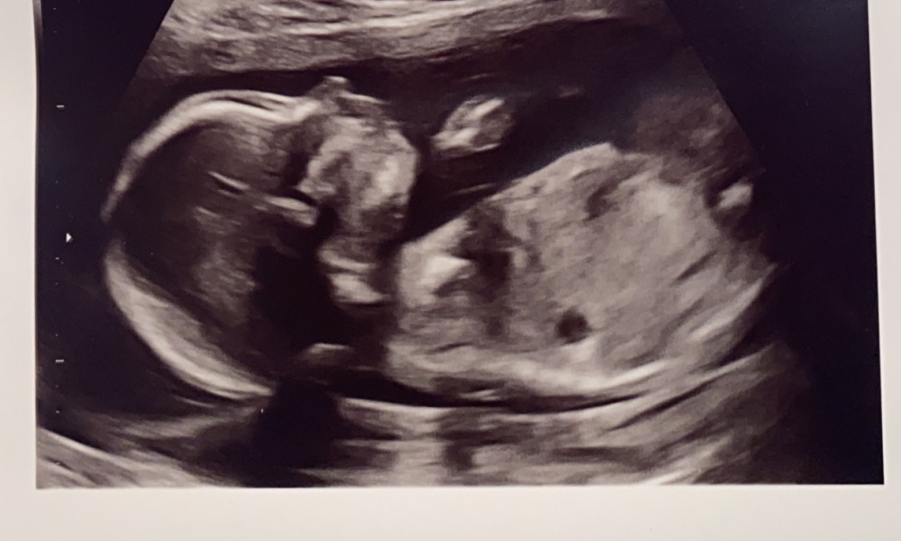 5 Month Scan Guess