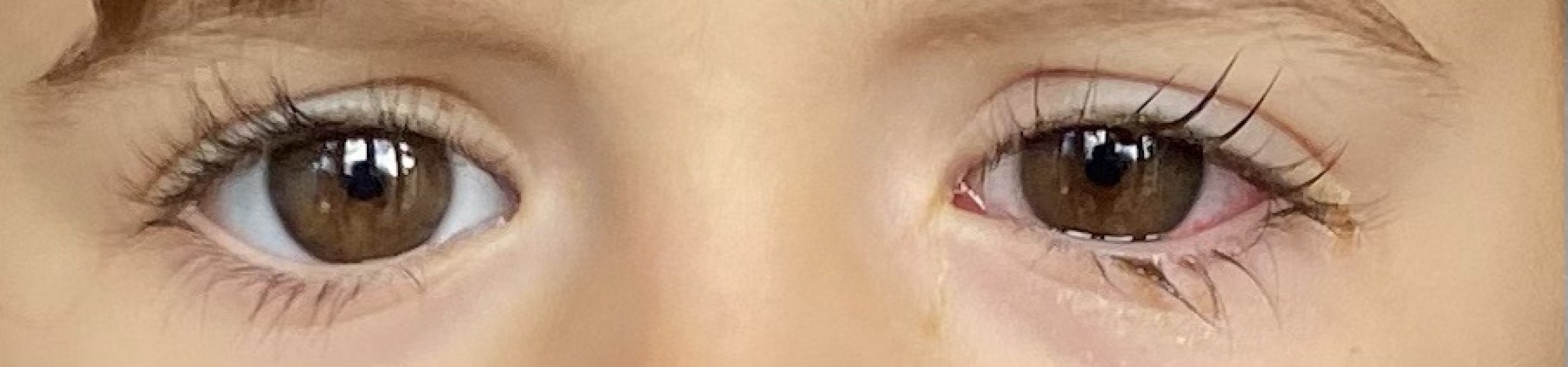 Daughter sore eye & fever
