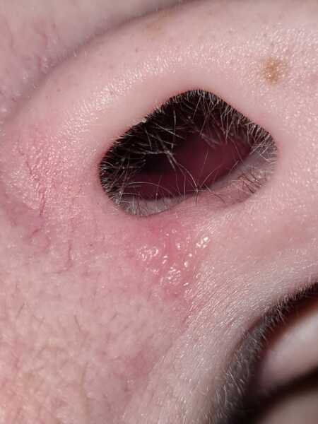 Skin cancer referral- terrified 