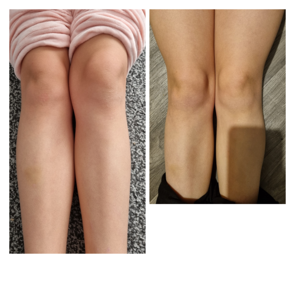 Child joint pains 