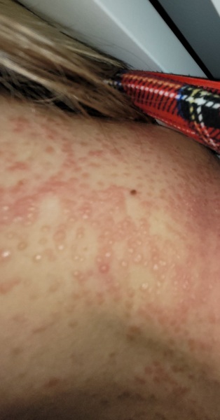 Please help me identify this rash