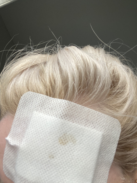 Scald on face, help!