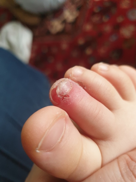 TW gross toe image. Is this ingrown nail or something else?