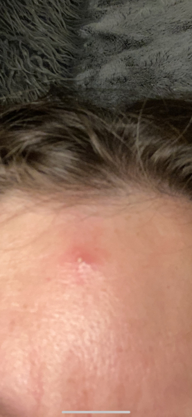 Bumped my head