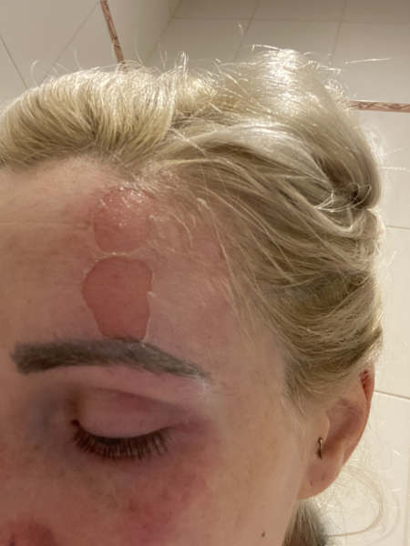 Scald on face, help!