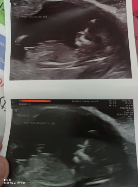 Nub theory guesses 13 weeks 