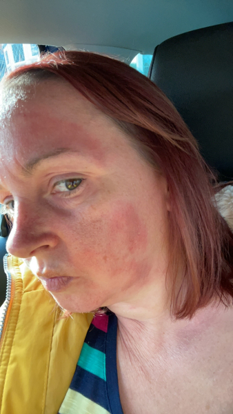 Please help identify this rash