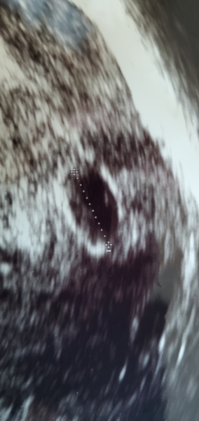 5 weeks 6days scan, no yolk sac
