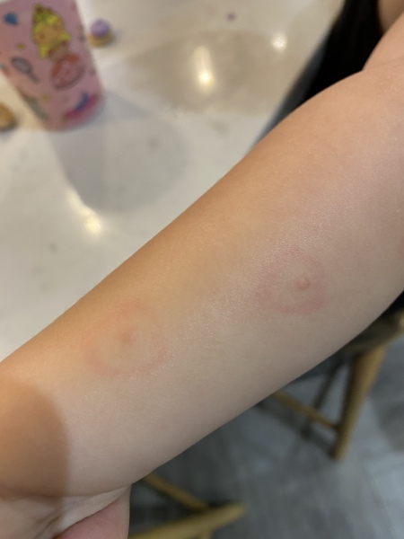 Chicken pox?