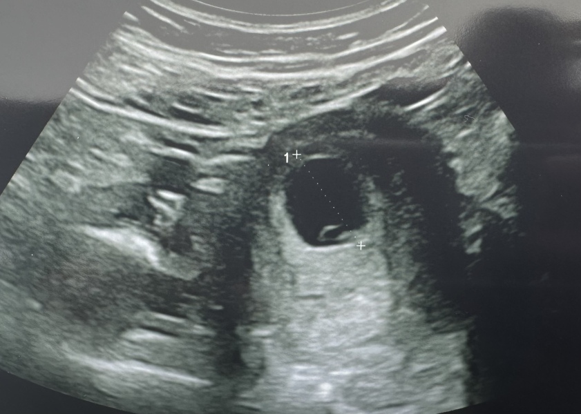 Did they see anything on your early scan?