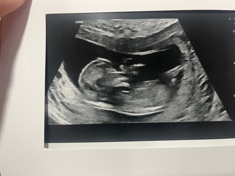 Gender guesses welcome… also when did people book a private gender scan for ?