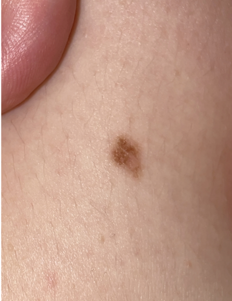 Dodgy looking mole