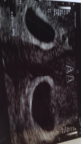 Did they see anything on your early scan?