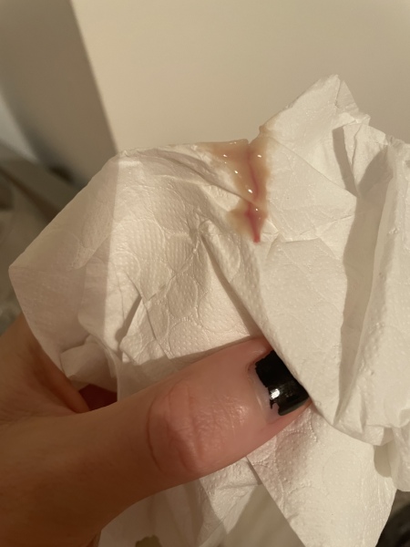 Help me - infected cyst