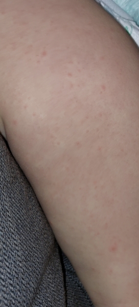 Is this chicken pox?